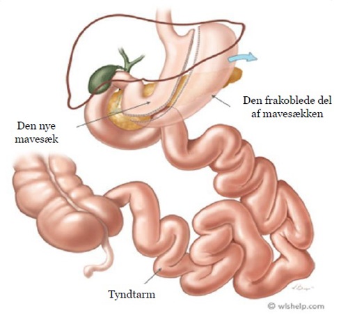 Illustration af Gastric Sleeve operation